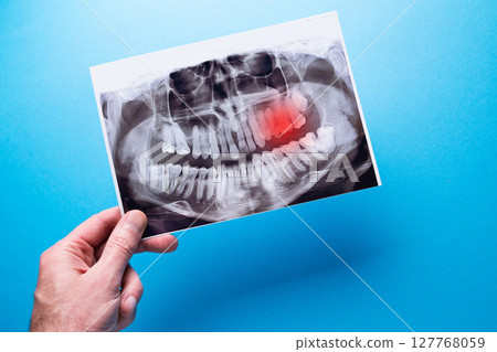 A dentist points to a problem area on a dental X-ray, highlighted in red. Concept of toothache and dental examination. A dentist points to a problem area on a dental X-ray, highlighted in red. Concept of toothache and dental examination. 127768059