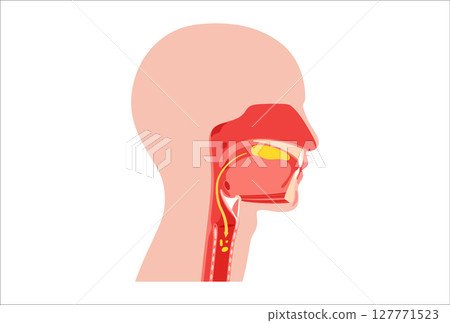 Aspiration pneumonia infection 127771523