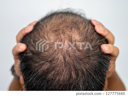 A bald spot on men's head. Baldness is related to your genes and male sex hormones. A bald spot on men's head. Baldness is related to your genes and male sex hormones. 127775660