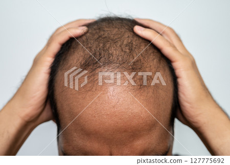Asian man touching his head and having stress becaused of baldness problem. 127775692