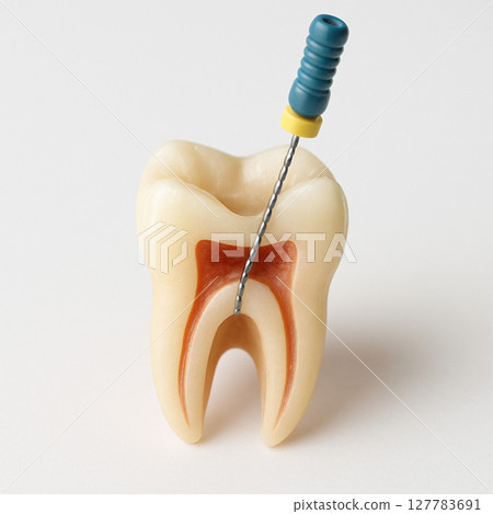 根管治療 神經治療 127783691