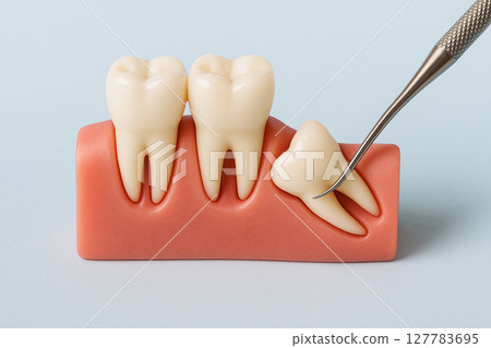 如何拔除智齒 127783695