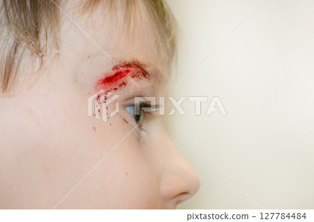 boy with a head wound boy with a head wound 127784484