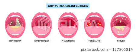 Oropharyngeal infections poster 127805814