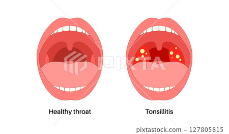 Tonsillitis Oral Desease 127805815