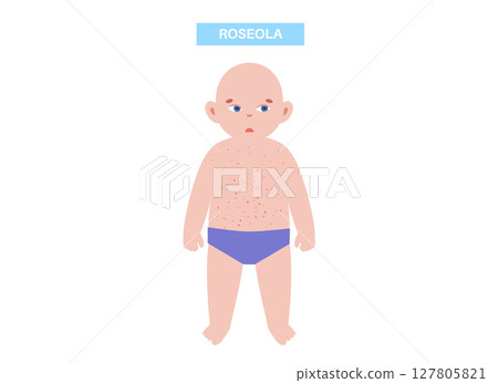 Roseola or exanthem subitum 127805821