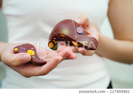 Chronic kidney disease, Asian woman with model for treatment urinary system, urology, Estimated glomerular filtration rate eGFR. 127809862