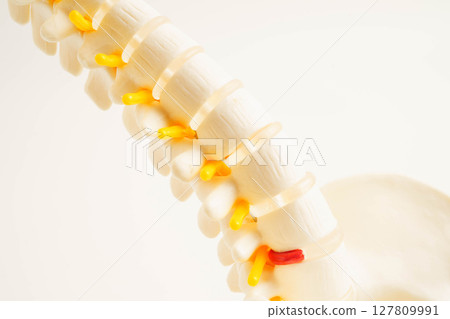 Spinal nerve and bone, Lumbar spine displaced herniated disc fragment, Model for treatment medical in the orthopedic department. Spinal nerve and bone, Lumbar spine displaced herniated disc fragment, Model for treatment medical in the orthopedic department. 127809991