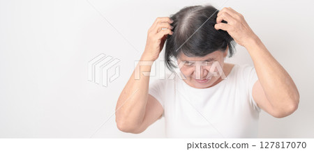 Elderly woman having itchy Scalp and Head hair, Dandruff, Dry Scalp, Skin Allergy Seborrheic dermatitis. Dermatology, Leprosy day, Systemic lupus erythematosus, SLE, Psoriasis and Atopic Eczema rash Elderly woman having itchy Scalp and Head hair, Dandruff, Dry Scalp, Skin Allergy Seborrheic dermatitis. Dermatology, Leprosy day, Systemic lupus erythematosus, SLE, Psoriasis and Atopic Eczema rash 127817070