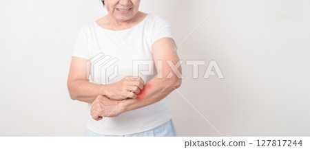 Elderly woman itching arm and body scratching for Skin Allergy from insect bite and food dermatitis. Dermatology, Leprosy day, Systemic lupus erythematosus, Psoriasis, Urticaria and rash Eczema Elderly woman itching arm and body scratching for Skin Allergy from insect bite and food dermatitis. Dermatology, Leprosy day, Systemic lupus erythematosus, Psoriasis, Urticaria and rash Eczema 127817244