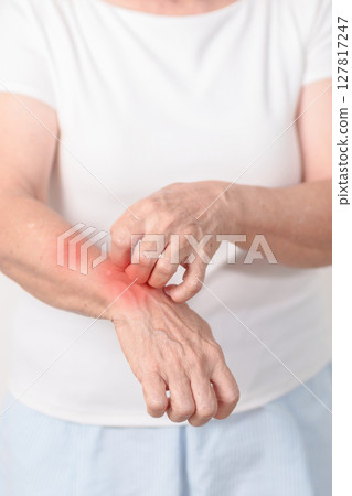 Elderly woman itching arm and body scratching for Skin Allergy from insect bite and food dermatitis. Dermatology, Leprosy day, Systemic lupus erythematosus, Psoriasis, Urticaria and rash Eczema Elderly woman itching arm and body scratching for Skin Allergy from insect bite and food dermatitis. Dermatology, Leprosy day, Systemic lupus erythematosus, Psoriasis, Urticaria and rash Eczema 127817247