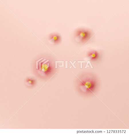 嚴重紅色痤瘡和發炎的治療圖像，美容皮膚科的 3D 插圖 127833572