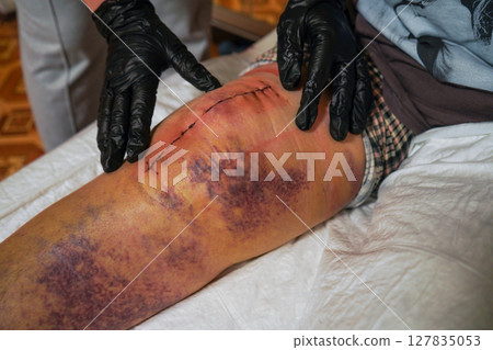 A physician is examining an elderly female patient who has undergone knee replacement surgery with an endoprosthesis. 127835053