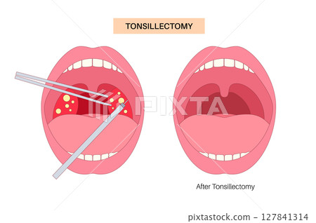 Tonsillectomy procedure poster 127841314