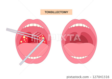 Tonsillectomy procedure poster 127841316