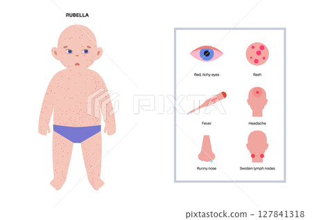 Measles or rubeola symptoms 127841318