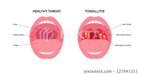 Tonsillitis Oral Desease Tonsillitis Oral Desease 127841321