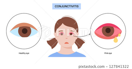 Conjunctivitis medical poster 127841322