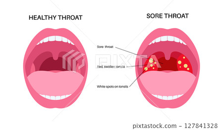 Sore throat poster 127841328
