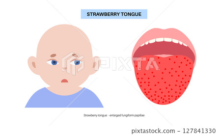 Strawberry tongue poster 127841330