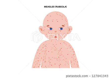 Measles or rubeola symptoms. 127841343