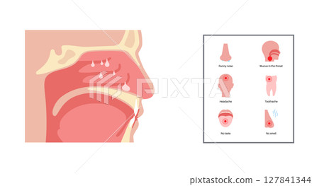 Nasal Polyps poster Nasal Polyps poster 127841344