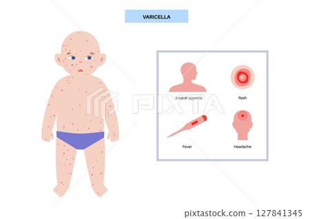 Varicella medical poster 127841345