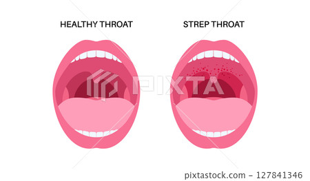 Strep throat poster 127841346