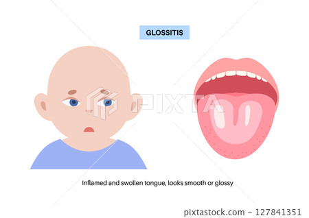Glossitis medical poster 127841351