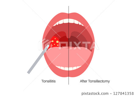 Tonsillectomy procedure poster Tonsillectomy procedure poster 127841358