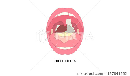 diphtheria oral disease 127841362