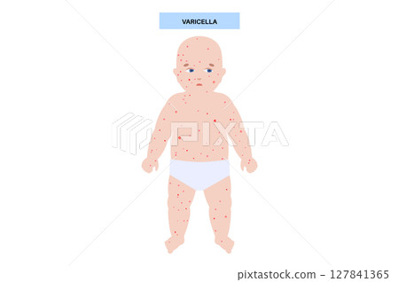 Varicella medical poster Varicella medical poster 127841365