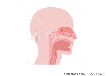 Nasal Polyps poster Nasal Polyps poster 127841370