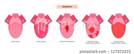 Tongue disease poster 127872835