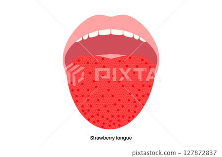 Strawberry tongue poster 127872837