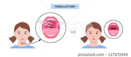 Tonsillectomy procedure poster Tonsillectomy procedure poster 127872840