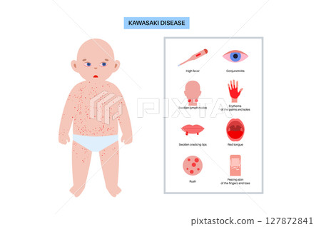 Roseola or exanthem subitum Roseola or exanthem subitum 127872841