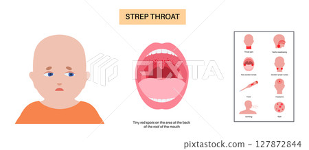 Strep throat poster Strep throat poster 127872844