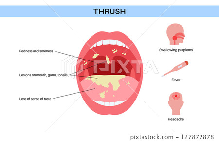 Thrush disease poster Thrush disease poster 127872878