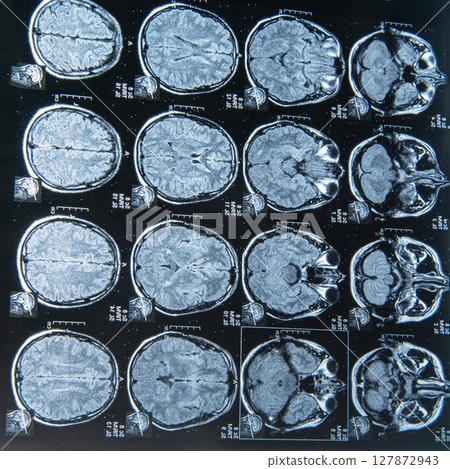MRI scan image of brain for diagnosis 127872943