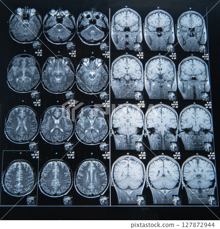 MRI scan image of brain for diagnosis 127872944