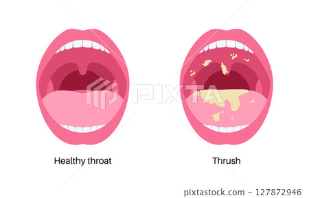 Thrush disease poster 127872946