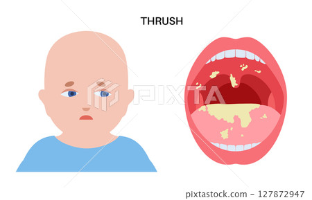 Thrush disease poster Thrush disease poster 127872947