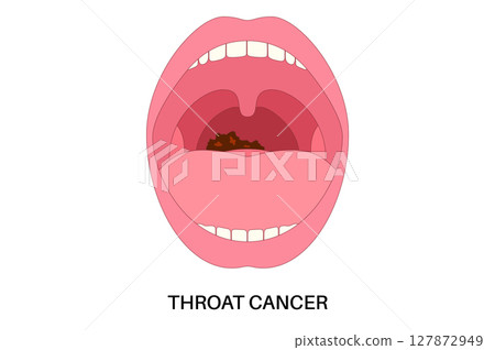 Throat cancer poster 127872949