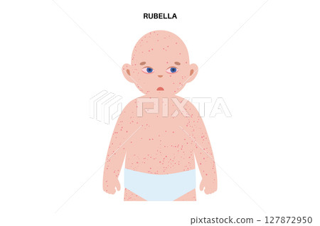 Measles or rubeola symptoms 127872950