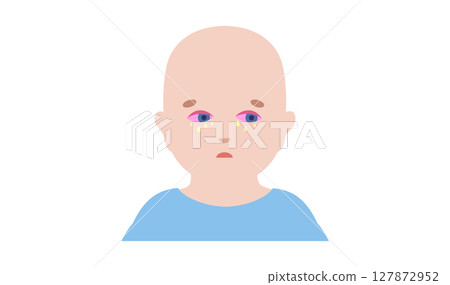 Conjunctivitis medical poster Conjunctivitis medical poster 127872952