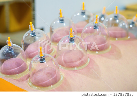 Close up for multiple vacuum cups, medical cupping therapy on human body. Doctor with cups for patient, therapy. Wellness, health injury rehabilitation concept. Alternative medicine Close up for multiple vacuum cups, medical cupping therapy on human body. Doctor with cups for patient, therapy. Wellness, health injury rehabilitation concept. Alternative medicine 127887853