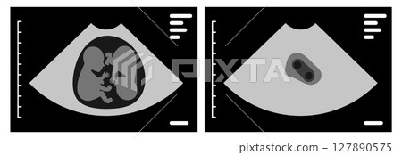 Ultrasound scan showing monozygotic twins during pregnancy 127890575