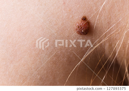 Closeup brown mole on caucasian woman skin. Closeup brown mole on caucasian woman skin. 127893375