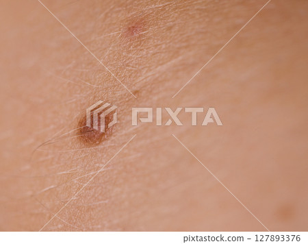 Closeup brown mole on caucasian woman skin. 127893376